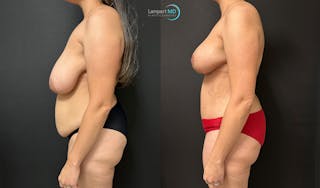 Mommy Makeover Before & After Gallery - Patient 224778 - Image 4