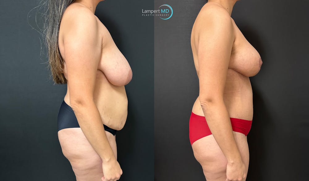 Breast Lift Before & After Gallery - Patient 263818 - Image 5