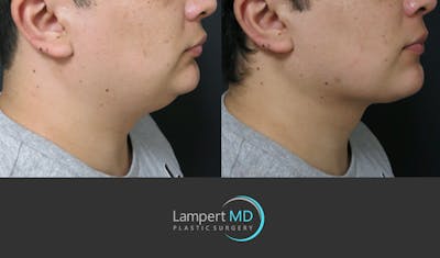 Chin Before & After Gallery - Patient 297874 - Image 1