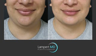 Chin Before & After Gallery - Patient 297874 - Image 2