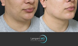 Chin Before & After Gallery - Patient 297874 - Image 3
