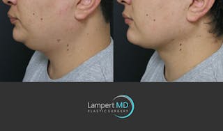 Chin Before & After Gallery - Patient 297874 - Image 4