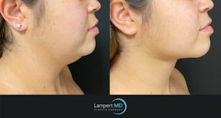 Chin Before & After Gallery - Patient 474814 - Image 1