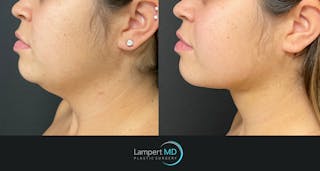 Chin Before & After Gallery - Patient 474814 - Image 2