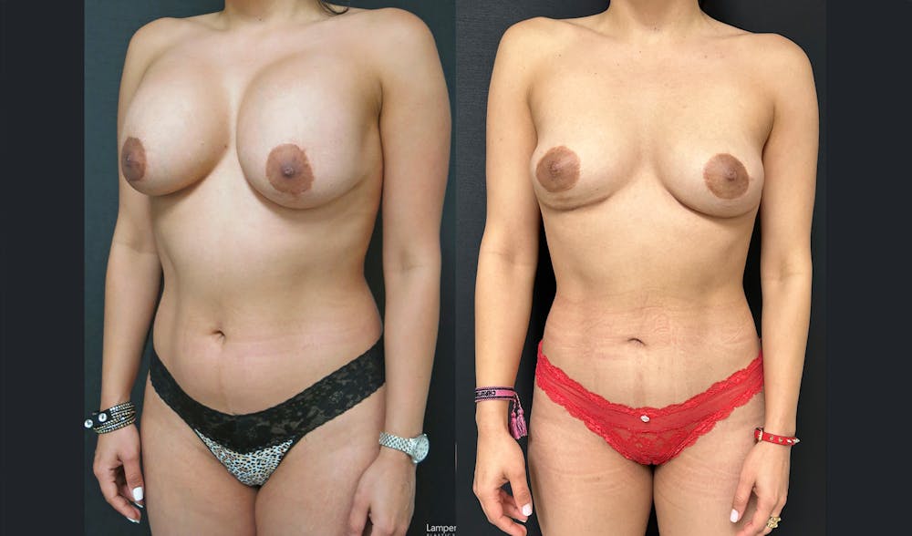 Breast Explant Before & After Gallery - Patient 122908837 - Image 2