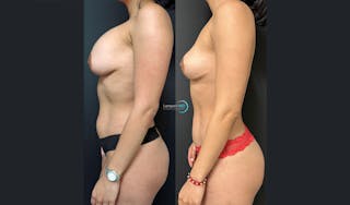 Breast Explant Before & After Gallery - Patient 122908837 - Image 3
