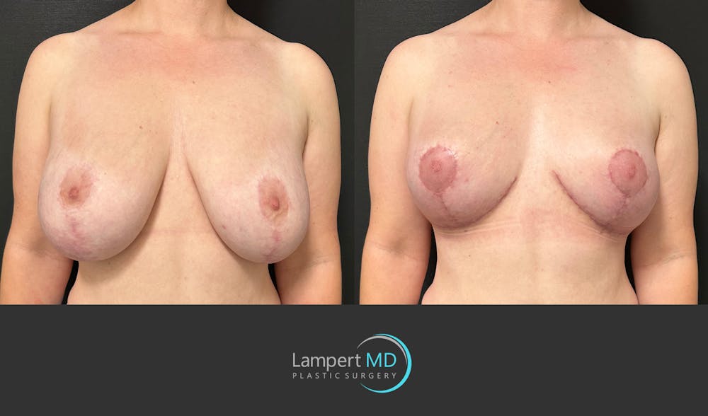 Breast Explant Before & After Gallery - Patient 329241 - Image 1