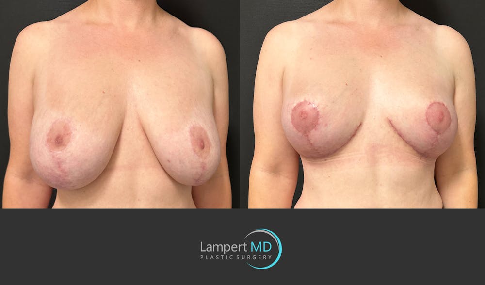 Breast Explant Before & After Gallery - Patient 329241 - Image 2
