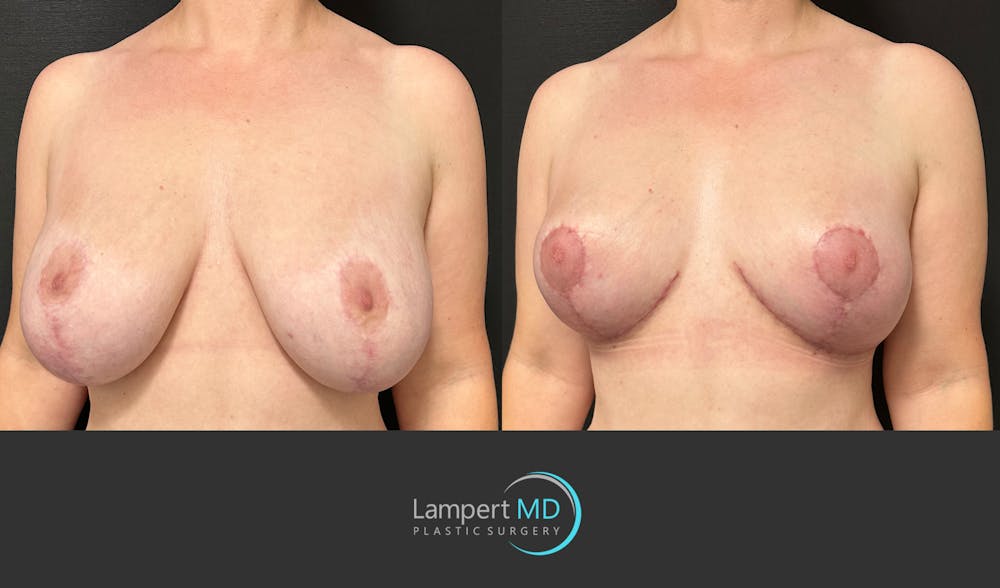 Breast Explant Before & After Gallery - Patient 329241 - Image 3