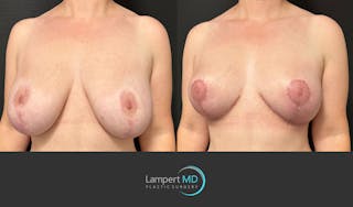Breast Explant Before & After Gallery - Patient 329241 - Image 3