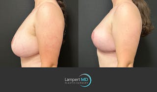 Breast Explant Before & After Gallery - Patient 329241 - Image 4