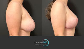 Breast Explant Before & After Gallery - Patient 329241 - Image 5