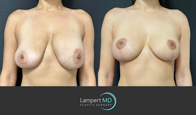 Breast Explant Before & After Gallery - Patient 184652162 - Image 1
