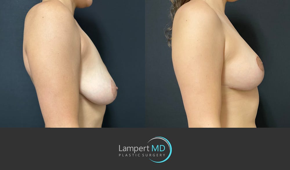 Breast Explant Before & After Gallery - Patient 184652162 - Image 5