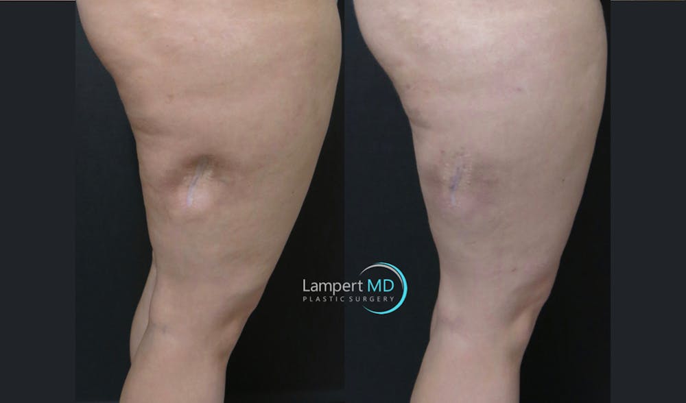 Scar Revision Before & After Gallery - Patient 279540 - Image 1