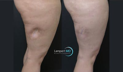 Scar Revision Before & After Gallery - Patient 279540 - Image 1
