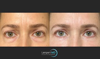 Eyelid Surgery Before & After Gallery - Patient 148049 - Image 1