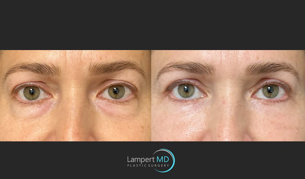 Eyelid Surgery Before & After Gallery - Patient 148049 - Image 2