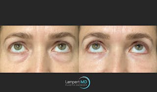 Eyelid Surgery Before & After Gallery - Patient 148049 - Image 3