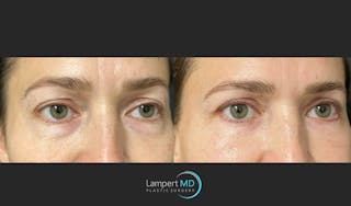 Eyelid Surgery Before & After Gallery - Patient 148049 - Image 4