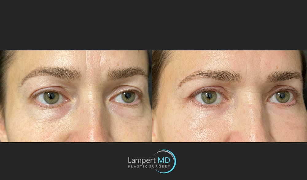 Eyelid Surgery Before & After Gallery - Patient 148049 - Image 4