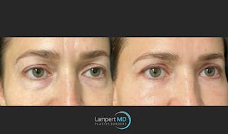 Eyelid Surgery Before & After Gallery - Patient 148049 - Image 4