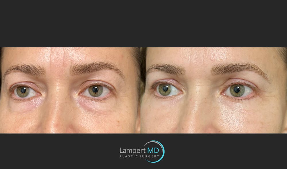 Eyelid Surgery Before & After Gallery - Patient 148049 - Image 5
