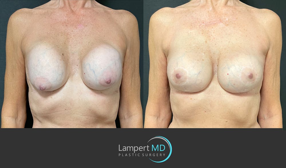 Breast Revision Before & After Gallery - Patient 144554872 - Image 1