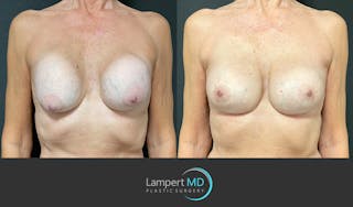 Breast Revision Before & After Gallery - Patient 144554872 - Image 1