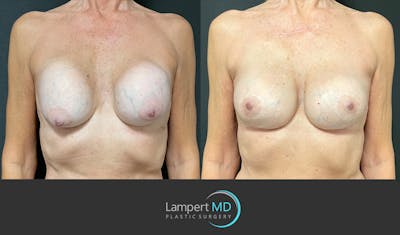 Breast Revision Before & After Gallery - Patient 144554872 - Image 1