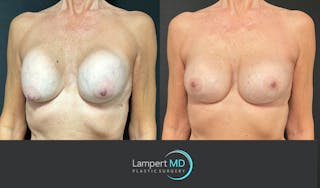 Breast Revision Before & After Gallery - Patient 144554872 - Image 2