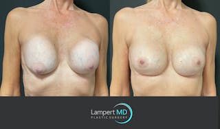 Breast Revision Before & After Gallery - Patient 144554872 - Image 3