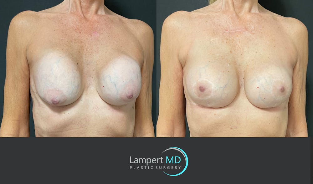 Breast Revision Before & After Gallery - Patient 144554872 - Image 3