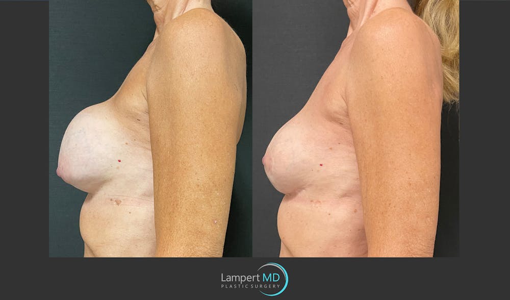 Breast Revision Before & After Gallery - Patient 144554872 - Image 4