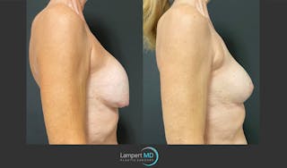 Breast Revision Before & After Gallery - Patient 144554872 - Image 5