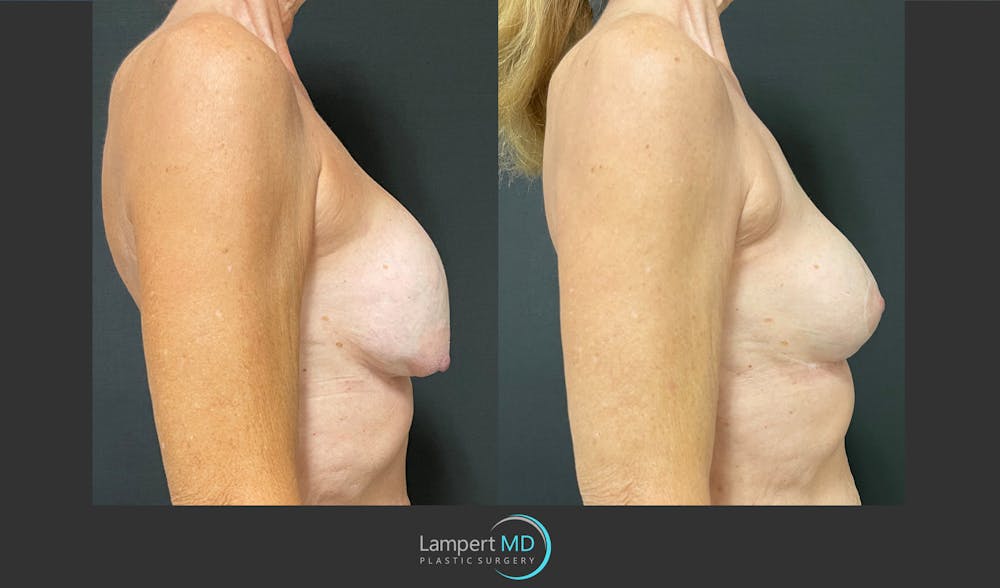 Breast Revision Before & After Gallery - Patient 144554872 - Image 5
