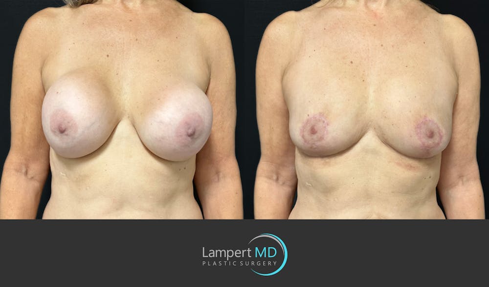 Breast Explant Before & After Gallery - Patient 174683 - Image 1