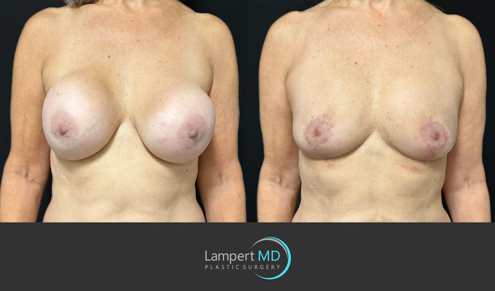 Breast Explant Before & After Gallery - Patient 157606 - Image 1