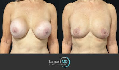 Breast Explant Before & After Gallery - Patient 157606 - Image 1