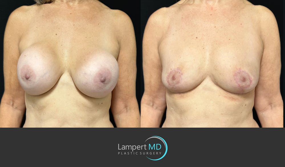 Breast Fat Transfer Before & After Gallery - Patient 771215 - Image 2