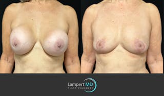 Breast Explant Before & After Gallery - Patient 174683 - Image 2
