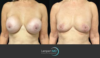 Breast Fat Transfer Before & After Gallery - Patient 771215 - Image 2