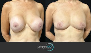 Breast Explant Before & After Gallery - Patient 174683 - Image 3