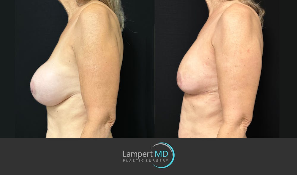 Breast Fat Transfer Before & After Gallery - Patient 771215 - Image 4