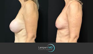 Breast Explant Before & After Gallery - Patient 157606 - Image 4