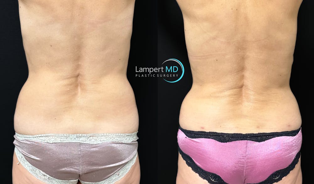 Breast Fat Transfer Before & After Gallery - Patient 771215 - Image 5