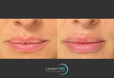 Lip Augmentation Before & After Gallery - Patient 122909263 - Image 1