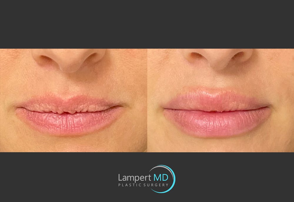Lip Augmentation Before & After Gallery - Patient 122909263 - Image 1