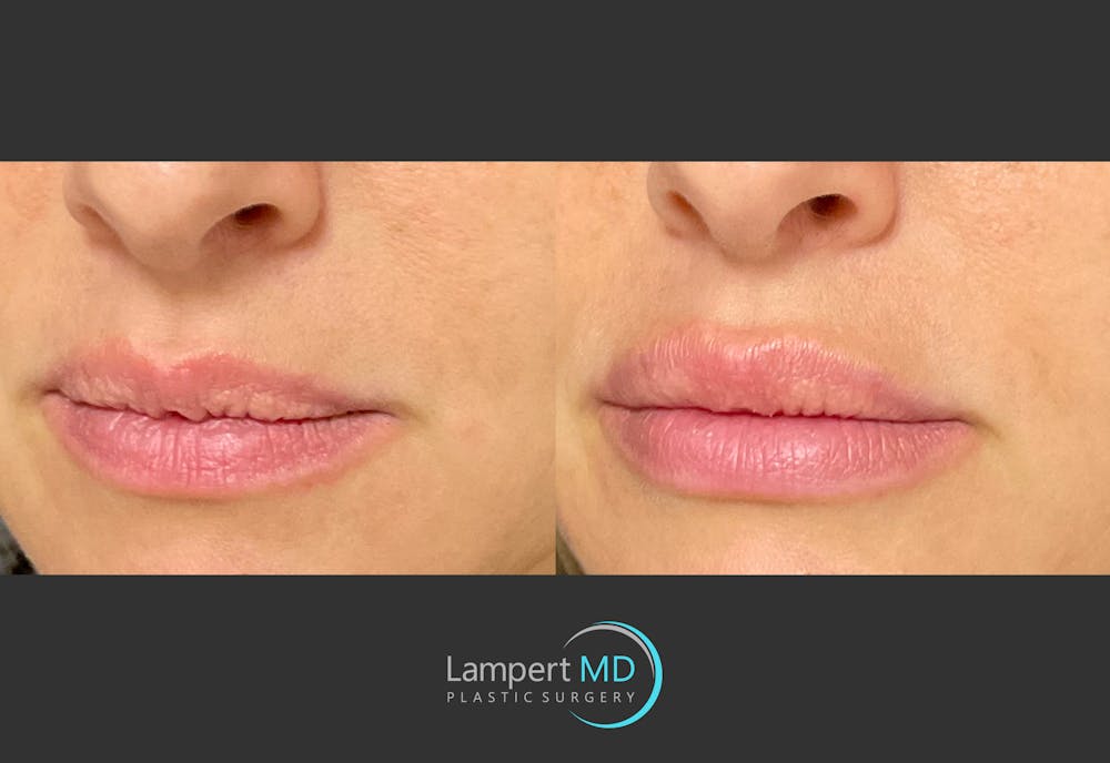 Lip Augmentation Before & After Gallery - Patient 122909263 - Image 2