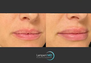 Lip Augmentation Before & After Gallery - Patient 122909263 - Image 3